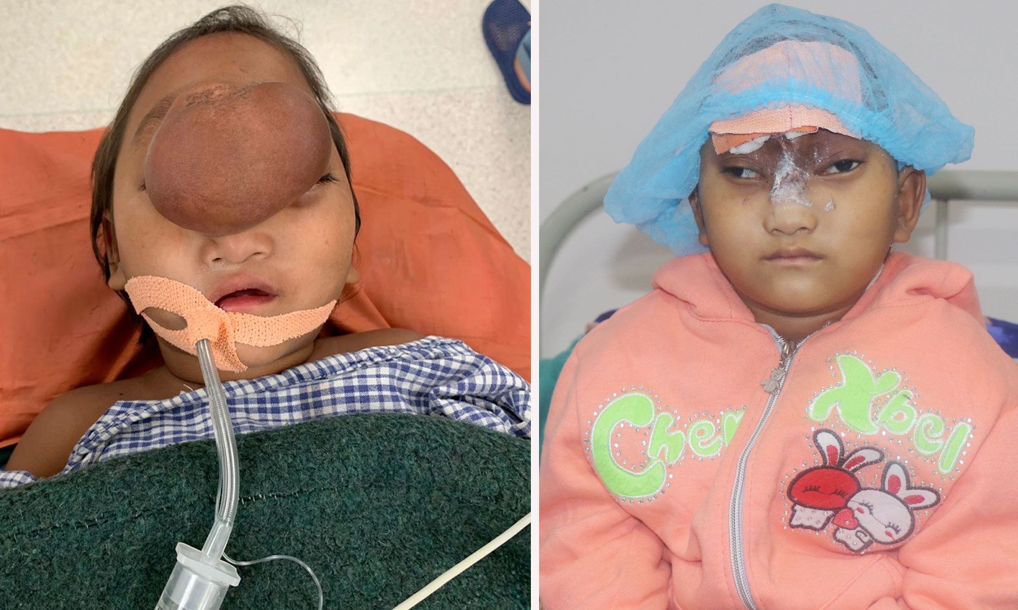 नोबेलको निःशुल्क उपचारले ५ बर्षे उमिसाले पाइन् नयाँ जीवन