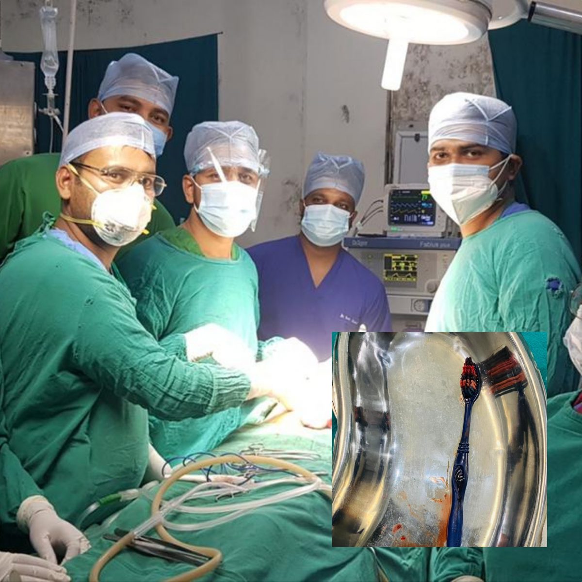 नोबेलमा शल्यक्रिया गरी पेटबाट निकालियो दाँत माझ्ने ब्रस